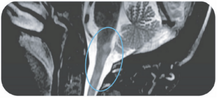 area-postrema-mri