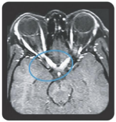 mri-bilateral-optic-neuritis-ms-vs-nmosd
