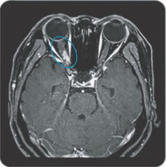 mri-posterior-involvement-optic-neuritis-ms-vs-nmosd
